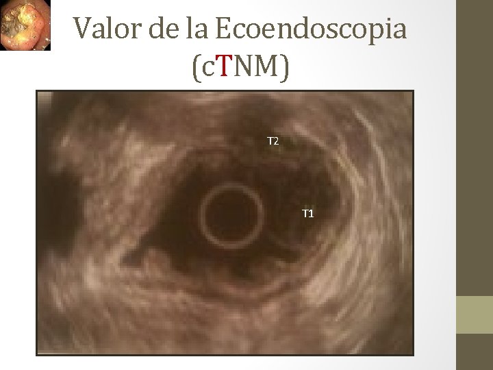 Valor de la Ecoendoscopia (c. TNM) T 2 T 1 