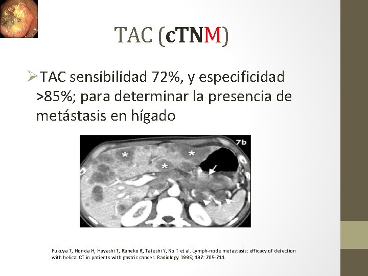 TAC (c. TNM) ØTAC sensibilidad 72%, y especificidad >85%; para determinar la presencia de