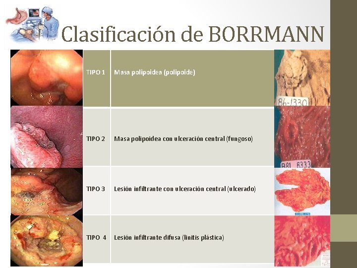 Clasificación de BORRMANN TIPO 1 Masa polipoidea (polipoide) TIPO 2 Masa polipoidea con ulceración