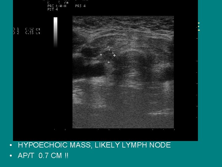 SEARCH FOR RECURRENT/RESIDUAL DISEASE • HYPOECHOIC MASS, LIKELY LYMPH NODE • AP/T 0. 7