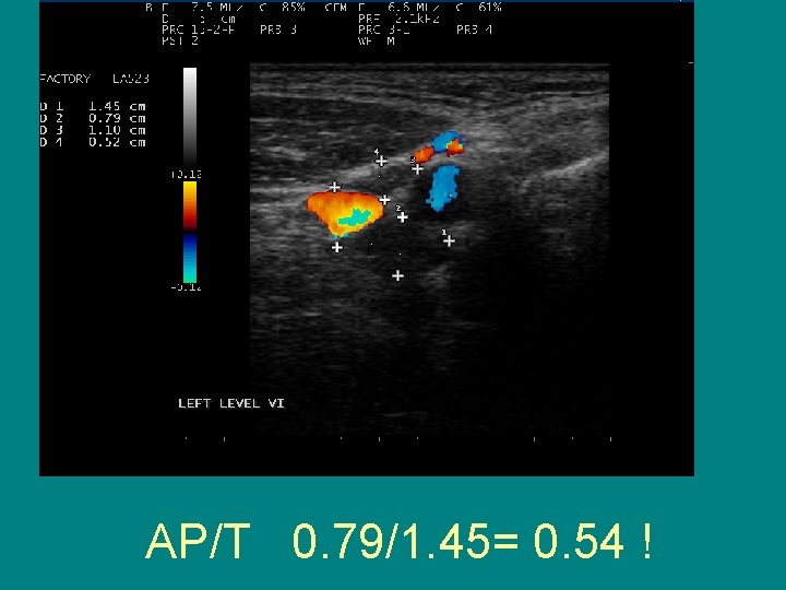 AP/T 0. 79/1. 45= 0. 54 ! 