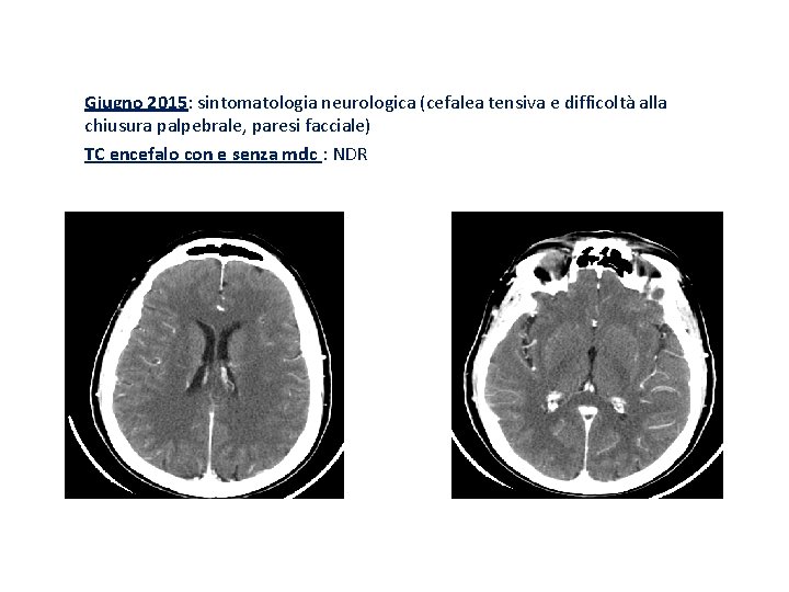 Giugno 2015: sintomatologia neurologica (cefalea tensiva e difficoltà alla chiusura palpebrale, paresi facciale) TC
