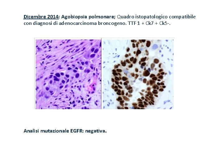 Dicembre 2014: Agobiopsia polmonare; Quadro istopatologico compatibile con diagnosi di adenocarcinoma broncogeno. TTF 1