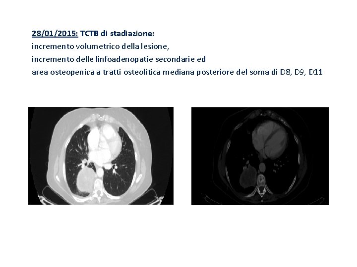 28/01/2015: TCTB di stadiazione: incremento volumetrico della lesione, incremento delle linfoadenopatie secondarie ed area