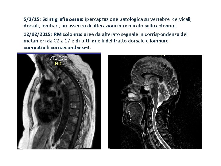 5/2/15: Scintigrafia ossea: ipercaptazione patologica su vertebre cervicali, dorsali, lombari, (in assenza di alterazioni