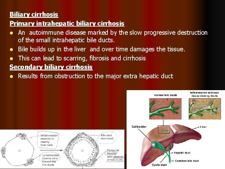 Biliary cirrhosis Primary intrahepatic biliary cirrhosis l An autoimmune disease marked by the slow