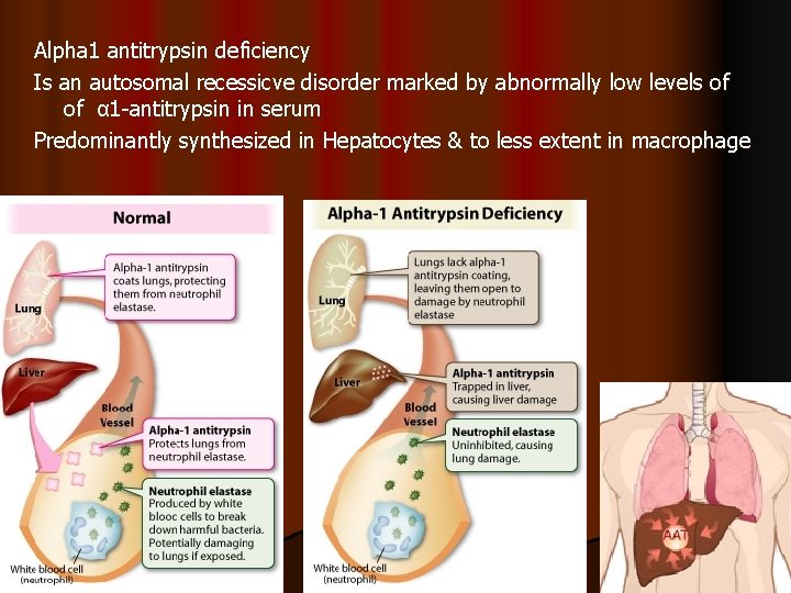 Alpha 1 antitrypsin deficiency Is an autosomal recessicve disorder marked by abnormally low levels