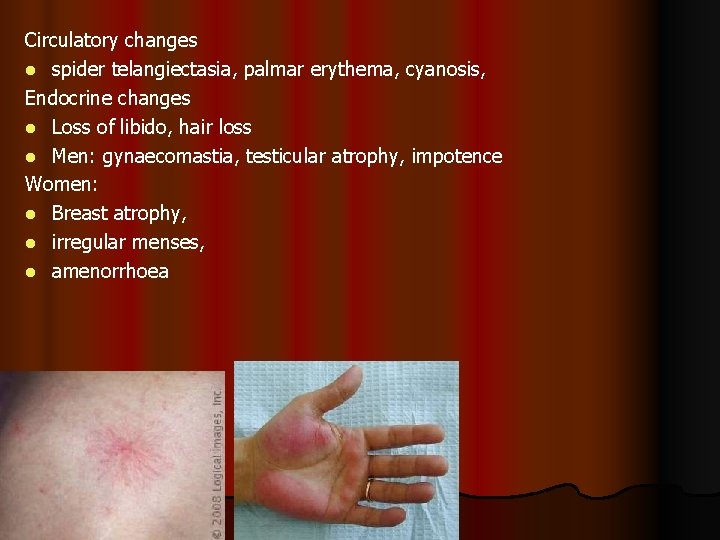Circulatory changes l spider telangiectasia, palmar erythema, cyanosis, Endocrine changes l Loss of libido,