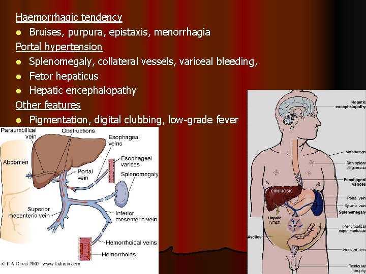 Haemorrhagic tendency l Bruises, purpura, epistaxis, menorrhagia Portal hypertension l Splenomegaly, collateral vessels, variceal