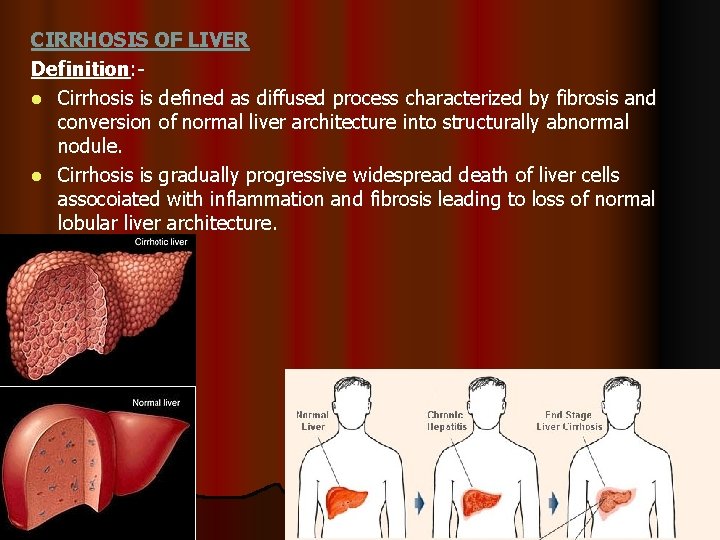 CIRRHOSIS OF LIVER Definition: l Cirrhosis is defined as diffused process characterized by fibrosis