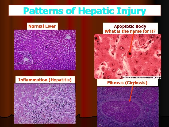 Patterns of Hepatic Injury Normal Liver Inflammation (Hepatitis) Apoptotic Body What is the name