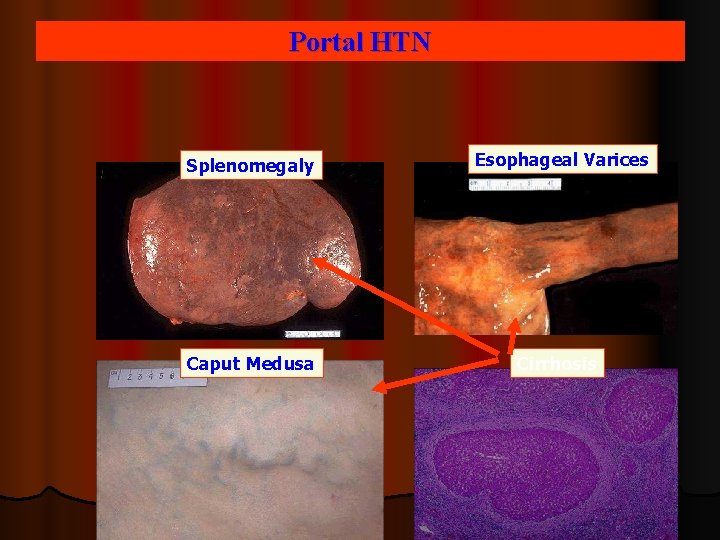 Portal HTN Splenomegaly Esophageal Varices Caput Medusa Cirrhosis 