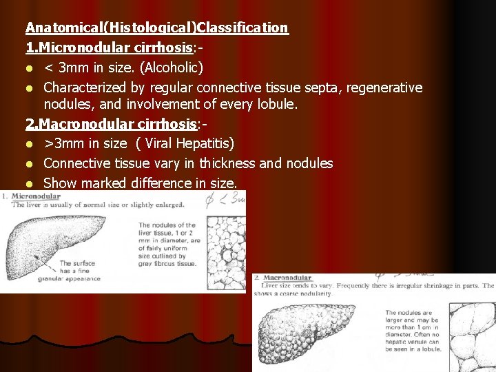 Anatomical(Histological)Classification 1. Micronodular cirrhosis: l < 3 mm in size. (Alcoholic) l Characterized by