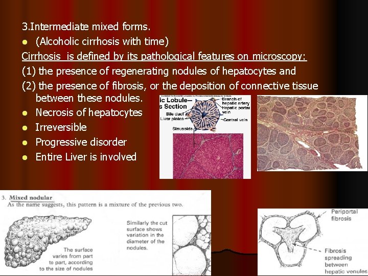 3. Intermediate mixed forms. l (Alcoholic cirrhosis with time) Cirrhosis is defined by its