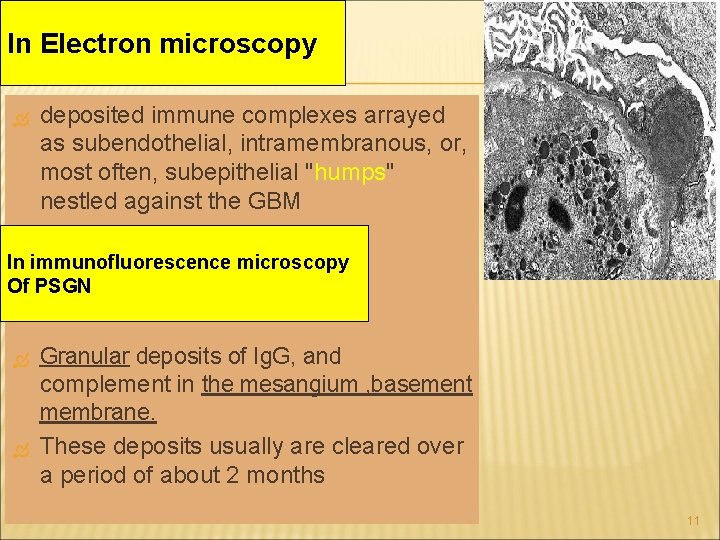 In Electron microscopy deposited immune complexes arrayed as subendothelial, intramembranous, or, most often, subepithelial