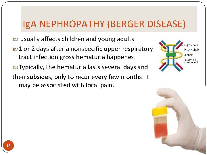 Ig. A NEPHROPATHY (BERGER DISEASE) usually affects children and young adults 1 or 2