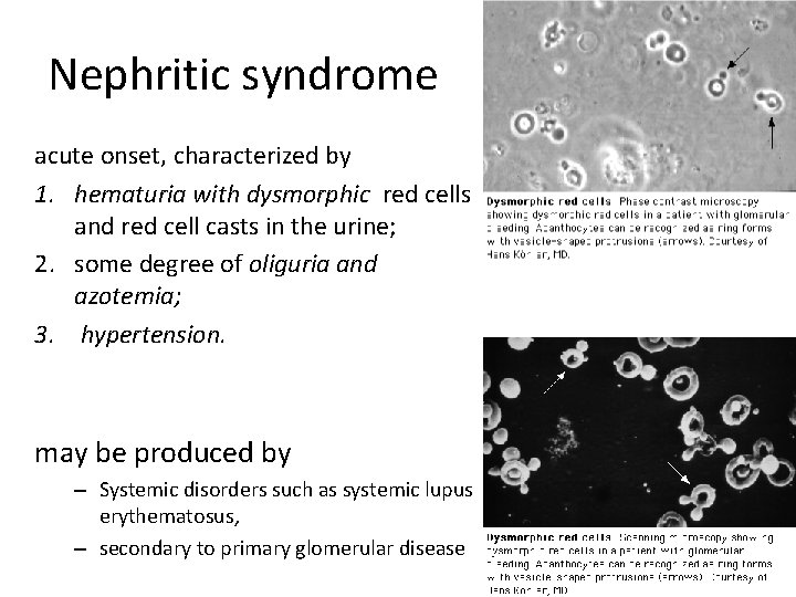 Nephritic syndrome acute onset, characterized by 1. hematuria with dysmorphic red cells and red