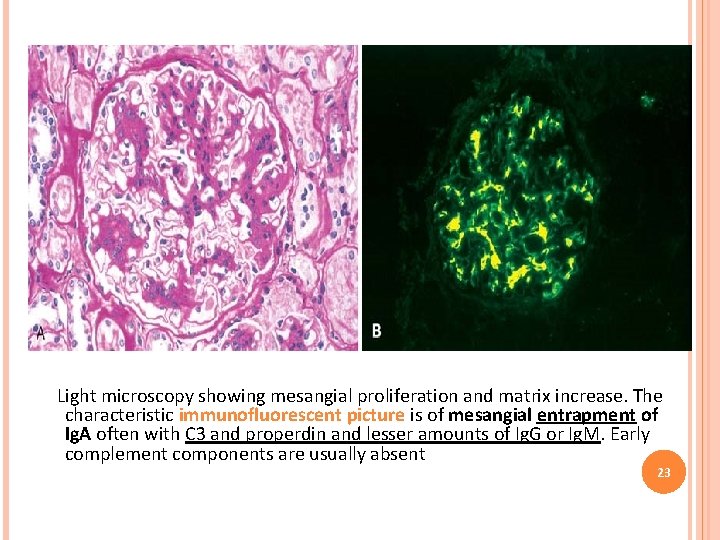 Light microscopy showing mesangial proliferation and matrix increase. The characteristic immunofluorescent picture is of