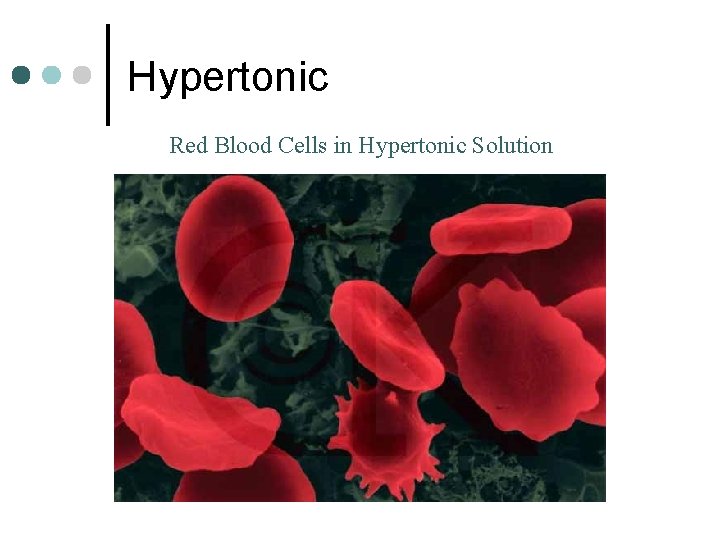 Hypertonic Red Blood Cells in Hypertonic Solution 