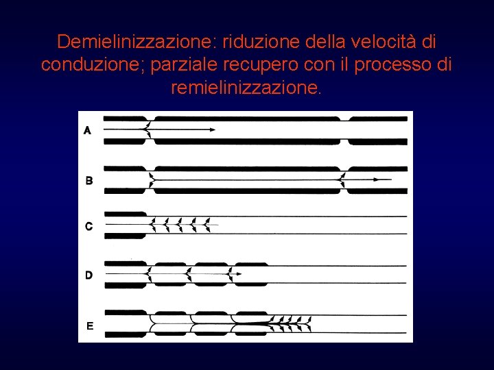 Demielinizzazione: riduzione della velocità di conduzione; parziale recupero con il processo di remielinizzazione. 