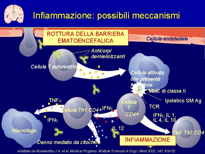 Infiammazione: possibili meccanismi ROTTURA DELLA BARRIERA EMATOENCEFALICA Cellula endoteliale Anticorpi demielinizzanti Cellula T autoreattiva