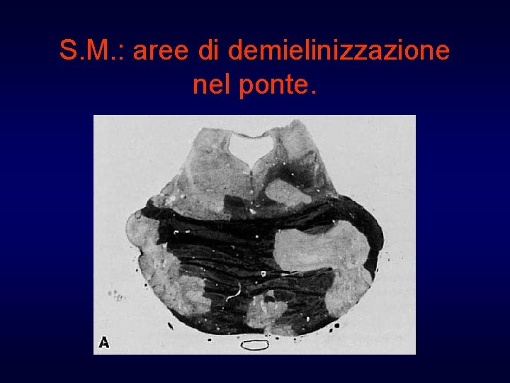 S. M. : aree di demielinizzazione nel ponte. 