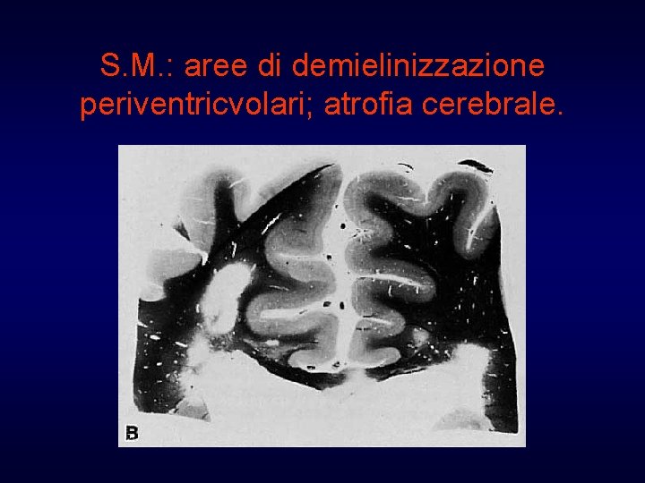 S. M. : aree di demielinizzazione periventricvolari; atrofia cerebrale. 