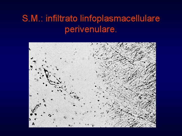 S. M. : infiltrato linfoplasmacellulare perivenulare. 