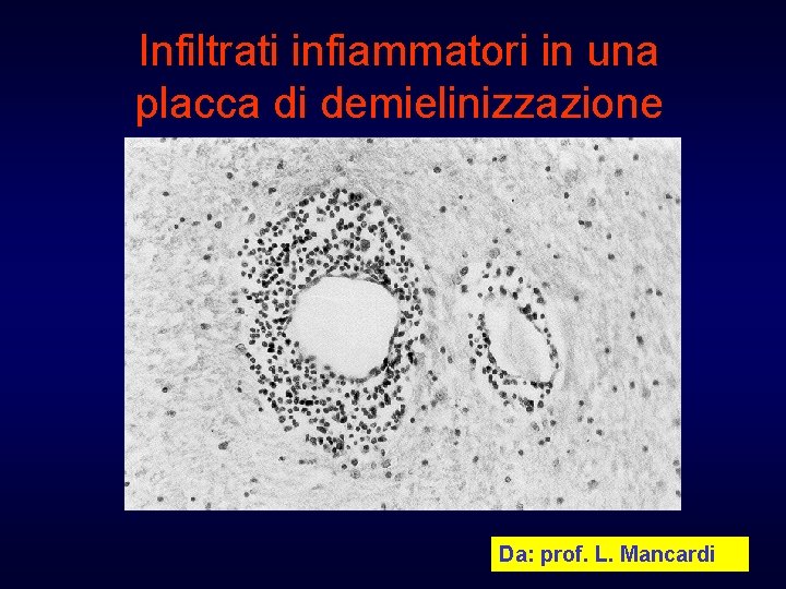 Infiltrati infiammatori in una placca di demielinizzazione Da: prof. L. Mancardi 