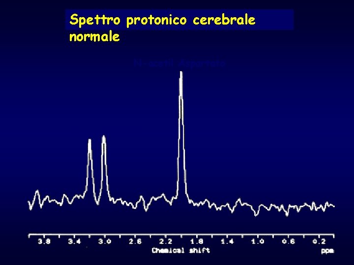 Spettro protonico cerebrale normale N-acetil Aspartato Colina Creatina 