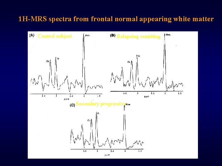 1 H-MRS spectra from frontal normal appearing white matter Control subject Relapsing remitting Secondary