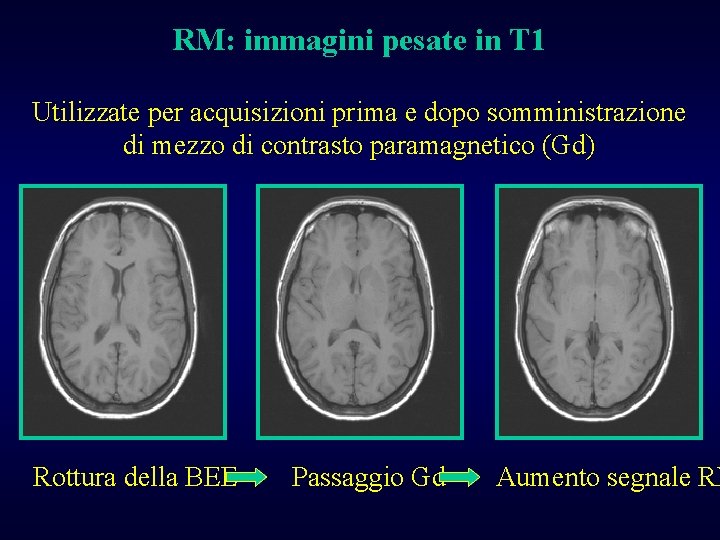 RM: immagini pesate in T 1 Utilizzate per acquisizioni prima e dopo somministrazione di