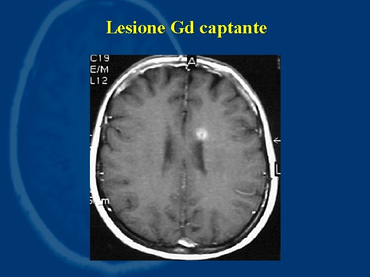 Lesione Gd captante 