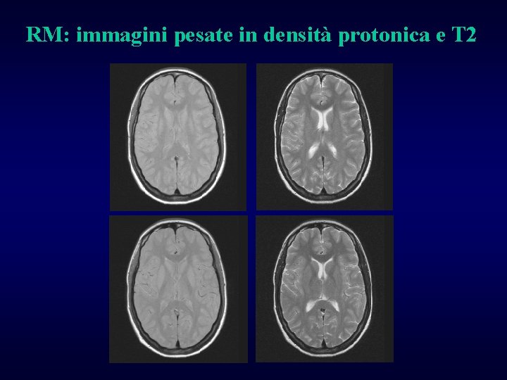 RM: immagini pesate in densità protonica e T 2 