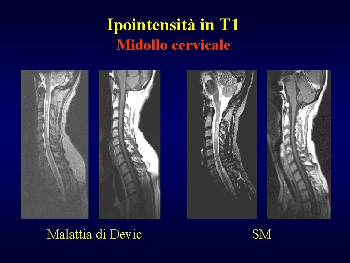 Ipointensità in T 1 Midollo cervicale Malattia di Devic SM 