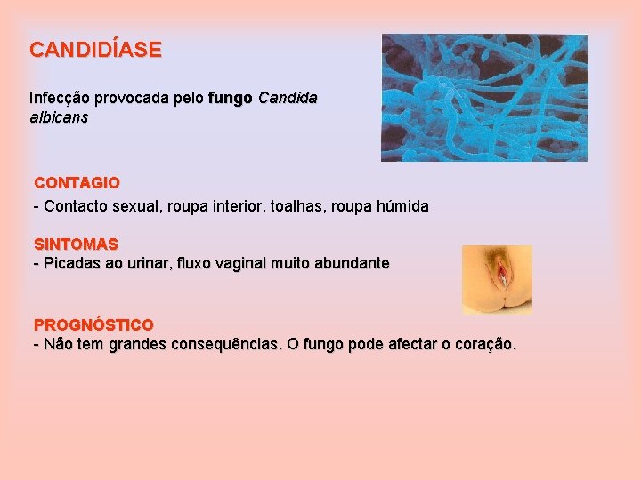 CANDIDÍASE Infecção provocada pelo fungo Candida albicans CONTAGIO - Contacto sexual, roupa interior, toalhas,