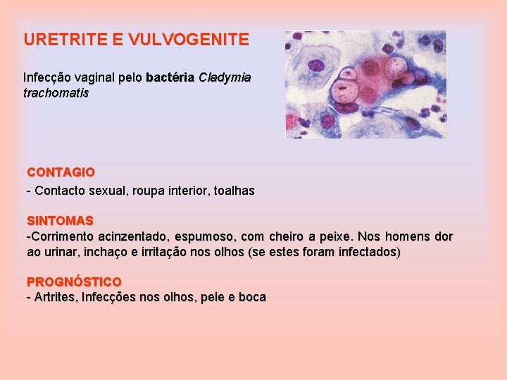 URETRITE E VULVOGENITE Infecção vaginal pelo bactéria Cladymia trachomatis CONTAGIO - Contacto sexual, roupa