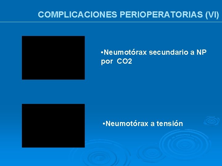 COMPLICACIONES PERIOPERATORIAS (VI) • Neumotórax secundario a NP por CO 2 • Neumotórax a