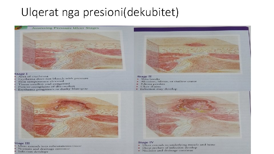 Ulqerat nga presioni(dekubitet) 