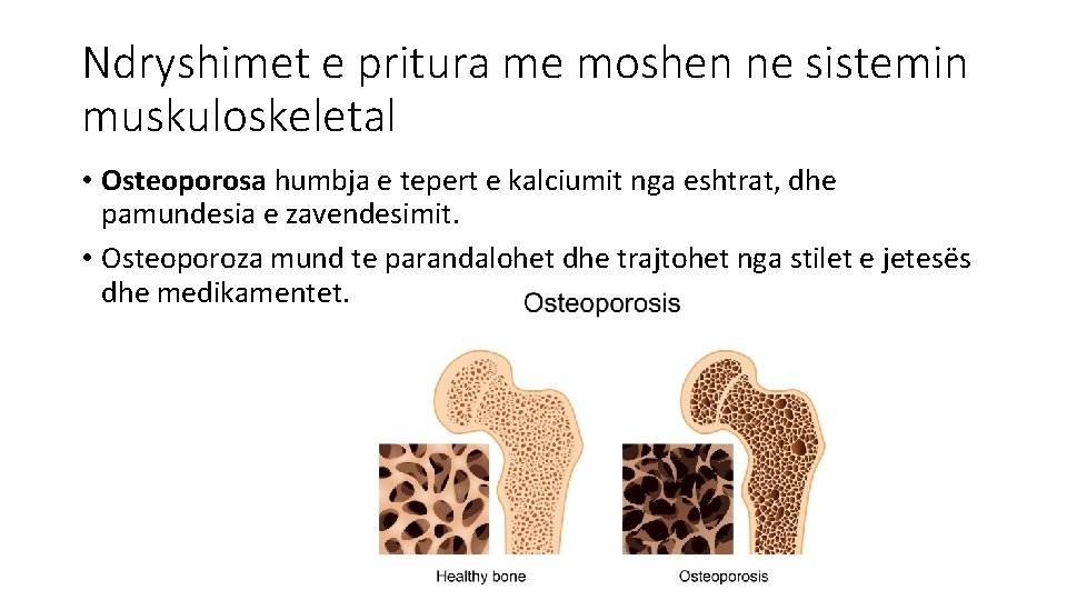 Ndryshimet e pritura me moshen ne sistemin muskuloskeletal • Osteoporosa humbja e tepert e