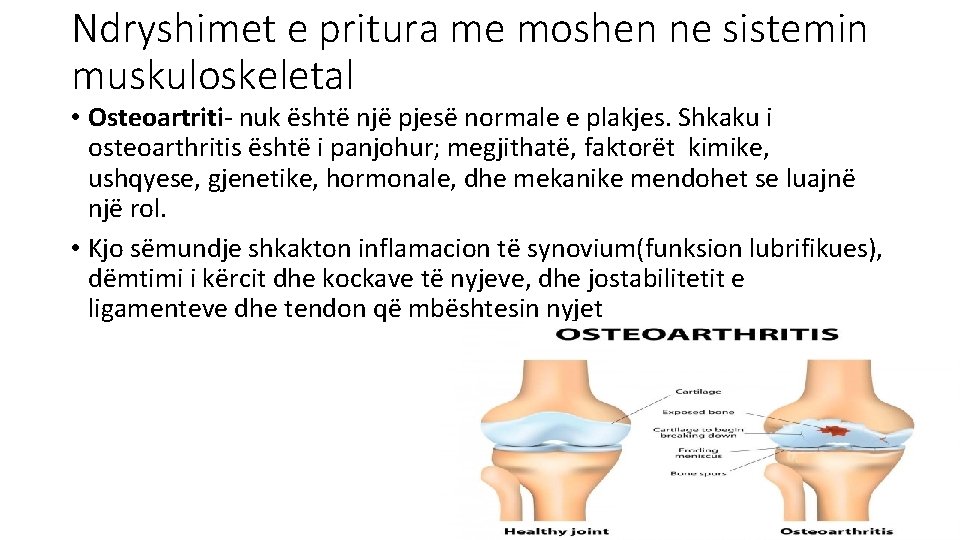 Ndryshimet e pritura me moshen ne sistemin muskuloskeletal • Osteoartriti- nuk është një pjesë