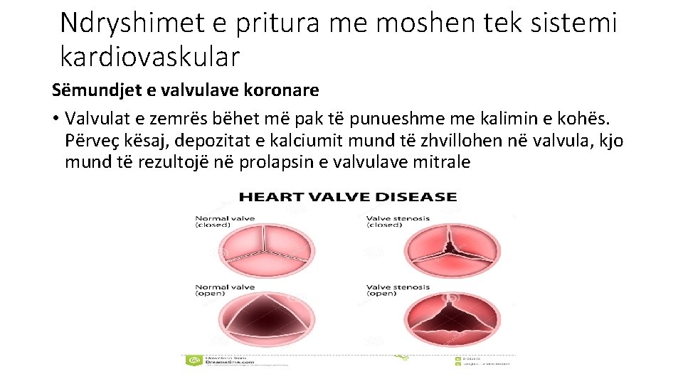 Ndryshimet e pritura me moshen tek sistemi kardiovaskular Sëmundjet e valvulave koronare • Valvulat