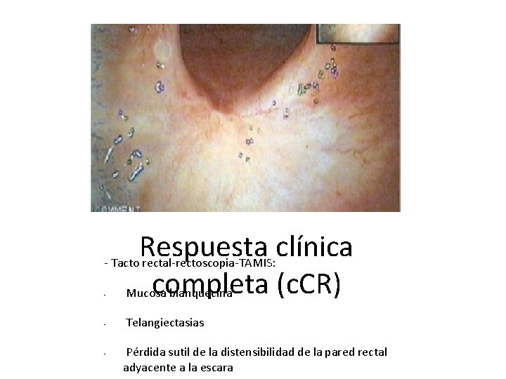 Respuesta clínica - Tacto rectal-rectoscopia-TAMIS: completa (c. CR) Mucosa blanquecina - - - Telangiectasias