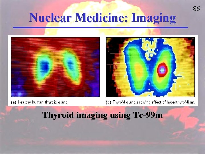 Nuclear Medicine: Imaging Thyroid imaging using Tc-99 m 86 