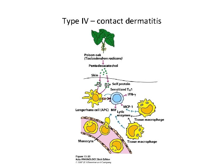 Type IV – contact dermatitis 