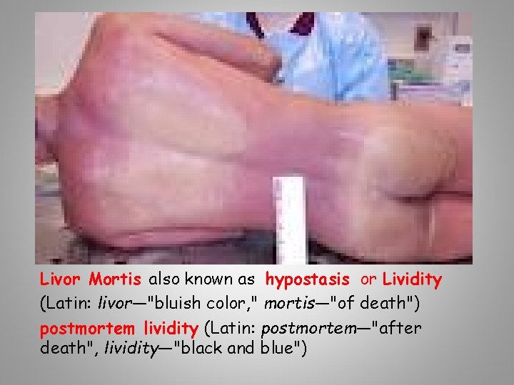 Livor Mortis also known as hypostasis or Lividity (Latin: livor—"bluish color, " mortis—"of death")