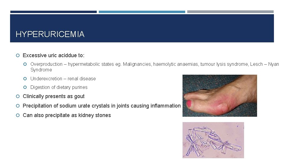 HYPERURICEMIA Excessive uric aciddue to: Overproduction – hypermetabolic states eg. Malignancies, haemolytic anaemias, tumour