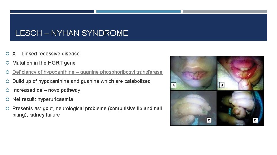 LESCH – NYHAN SYNDROME X – Linked recessive disease Mutation in the HGRT gene