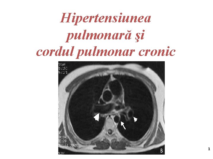 Hipertensiunea pulmonară şi cordul pulmonar cronic 1 