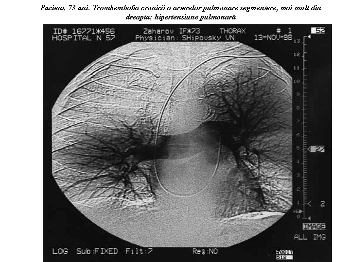 Pacient, 73 ani. Trombembolia cronică a arterelor pulmonare segmentere, mai mult din dreapta; hipertensiune
